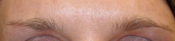 Dysport injections after 124631