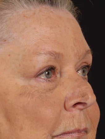 Blepharoplasty after 165948