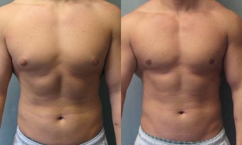 Gynecomastia after 350474