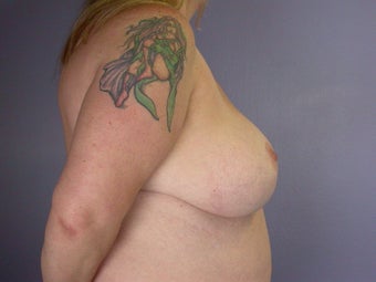 Breast Lift / Breast Augmentation after 291098