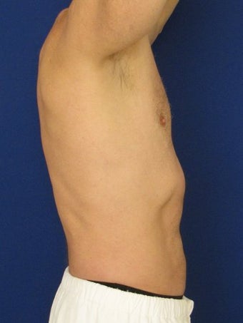 Vaser Hi Def Liposuction of chest, abdomen, back and flanks before 422689