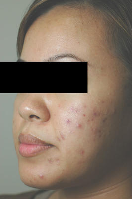 Laser Acne Treatment before 82975