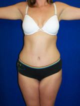 Tummy Tuck after Massive Weight Loss after 124953