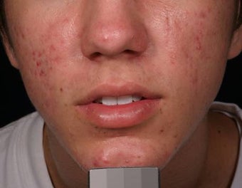 Acne laser treatment with PDT after 136715