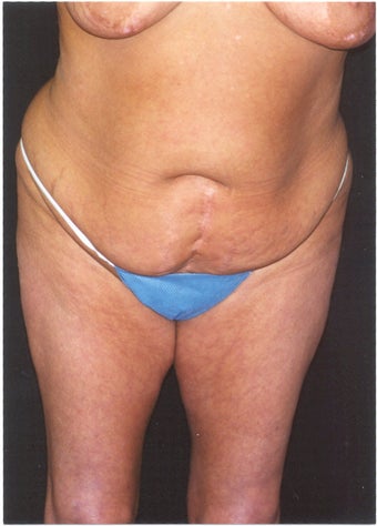 Body Lift before 379788