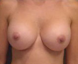 Breast Augmentation after 142509