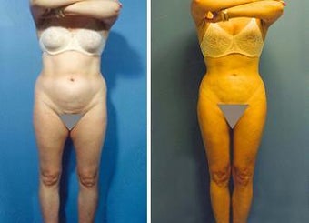 Liposuction before 636215