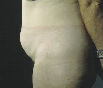 Lower body lift before 109950