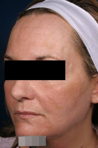 Fraxel - acne scars after 136194