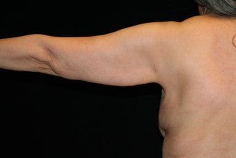 Arm Lift after 609007