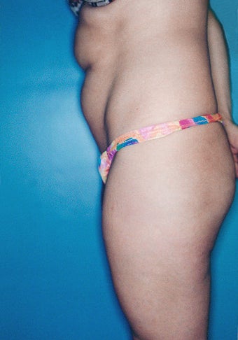 Power Assisted Liposuction (Hips, Thighs, Stomach & Back) before 276645