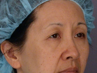 Eyelid Surgery before 324178
