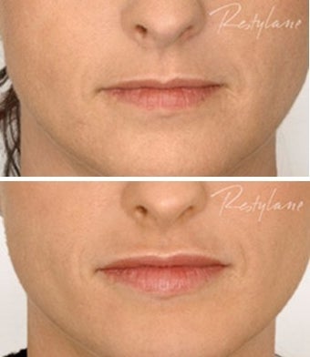 Resylane lip augmentation 1.0 ml before 6288