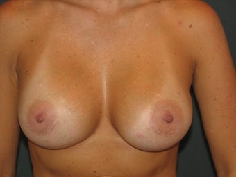 Breast Augmentation after 384406