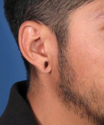 Gauge Earring Repair Otoplasty Surgery before 617423