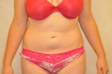 Liposuction of the abdomen after 267324