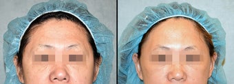 Endoscopic Brow/Forehead Lift before 649370