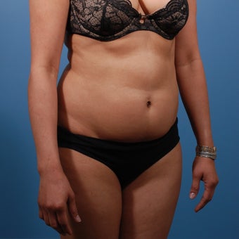 Liposuction before 207568
