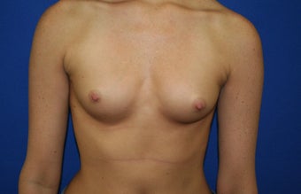 Breast implants before 241854