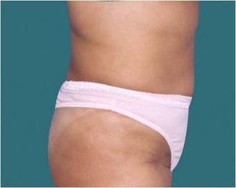 Liposuction 590650