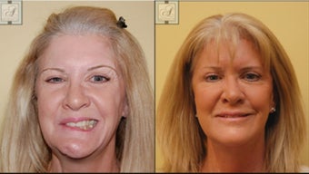 Facial Paralysis and Reconstruction before 346222