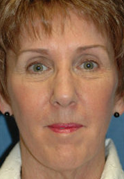 Neck Lift Surgery before 324030