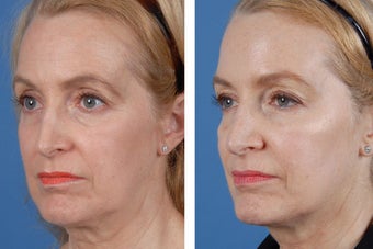 Restylane and Botox Cosmetic 356495