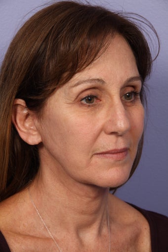 53 yr old Face and Necklift 622092