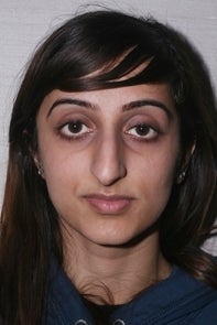 Asian Rhinoplasty before 448659