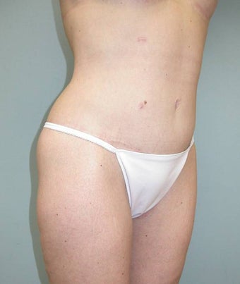 Lower Body Lift after 148604