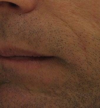 Belotero for fine etched-in lines in nasolabial folds after 633104