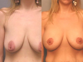 Breast Augmentation Special Situations before 131219