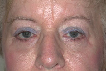 Upper and lower Blepharoplasty after 410972