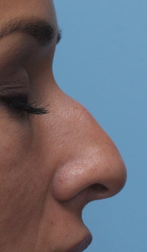 Non Surgical Rhinoplasty before 407867