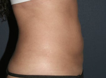 Liposculpture after 486622