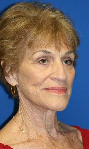 Facelift, Browlift, & Skin Pinch 540327
