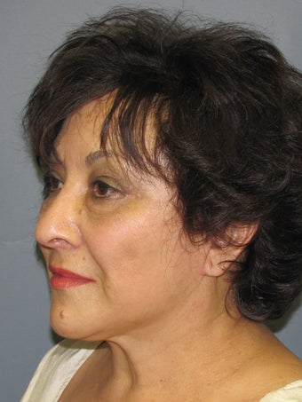 Neck Lift, Platysmaplasty 634736