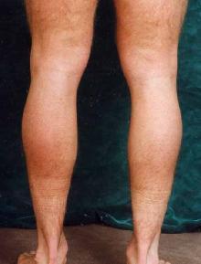 Men's Calf Augmentation before 519054