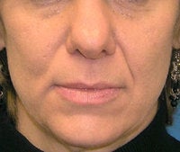 Volume Filler to Nasolabial Folds and Eye region before 52526