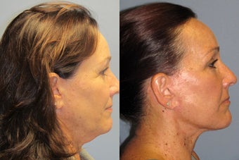 Lite Lift, Liposuction of the neck after 523449