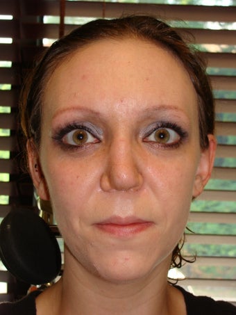 Rhinoplasty after 368032