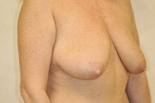 Breast Lift without Implants 341012