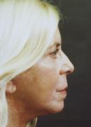 Facelift after 335839