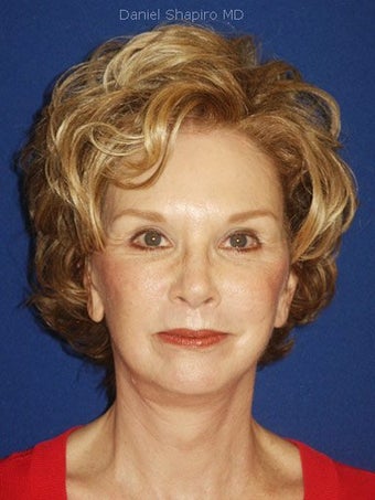 Facelift, Anterior Hairline Browlift, Upper and Lower Blepharoplasty, Perioral Dermabrasion after 248901