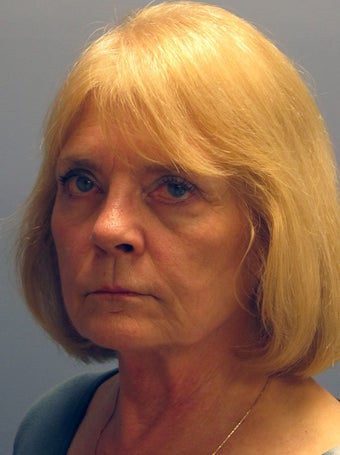 Neck Lift, Platysmaplasty 634746