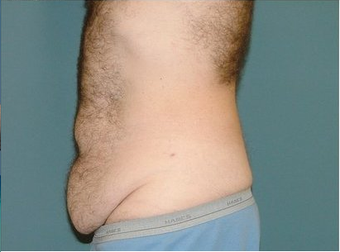 Tummy Tuck 97007