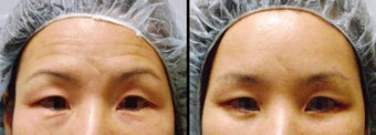 Endoscopic Brow Lift before 649408