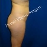 Liposuction 632169