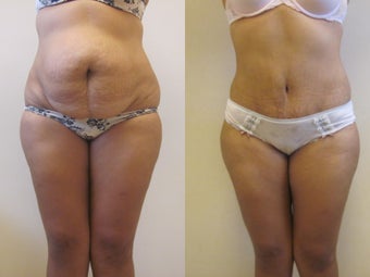 Tummy Tuck before 220788