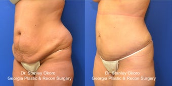 Mini Tummy Tuck after 568404